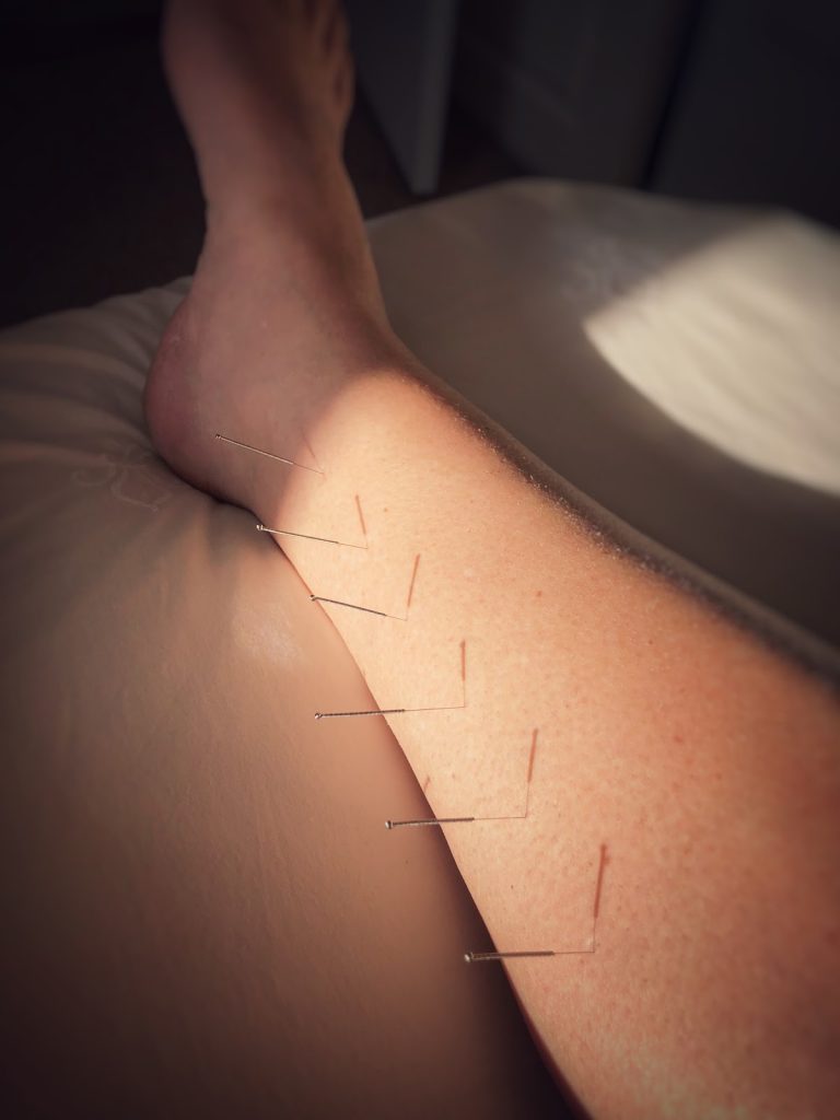 Acupuncture for pregnancy